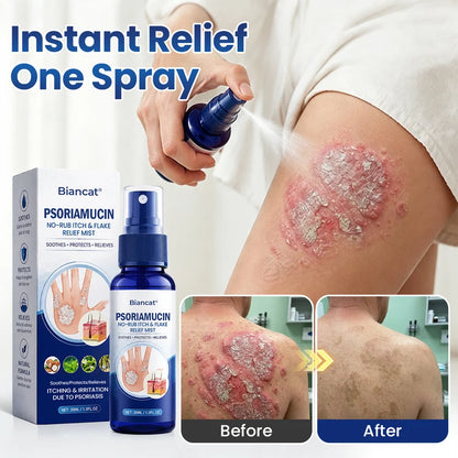 South Moon® PsoriaMucin No-Rub Itch & Flake Relief Mist