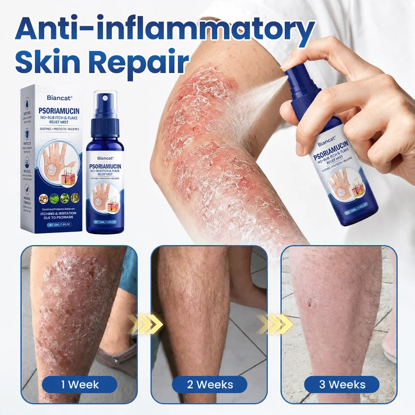 South Moon® PsoriaMucin No-Rub Itch & Flake Relief Mist