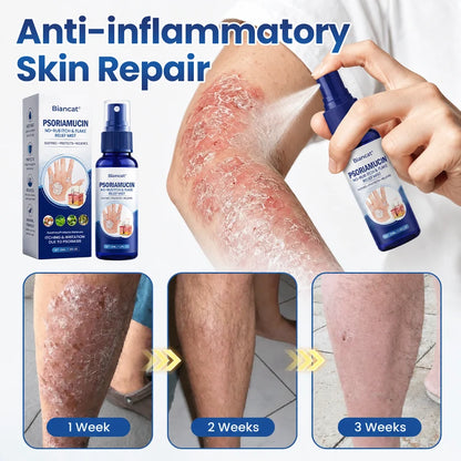 South Moon® PsoriaMucin No-Rub Itch & Flake Relief Mist