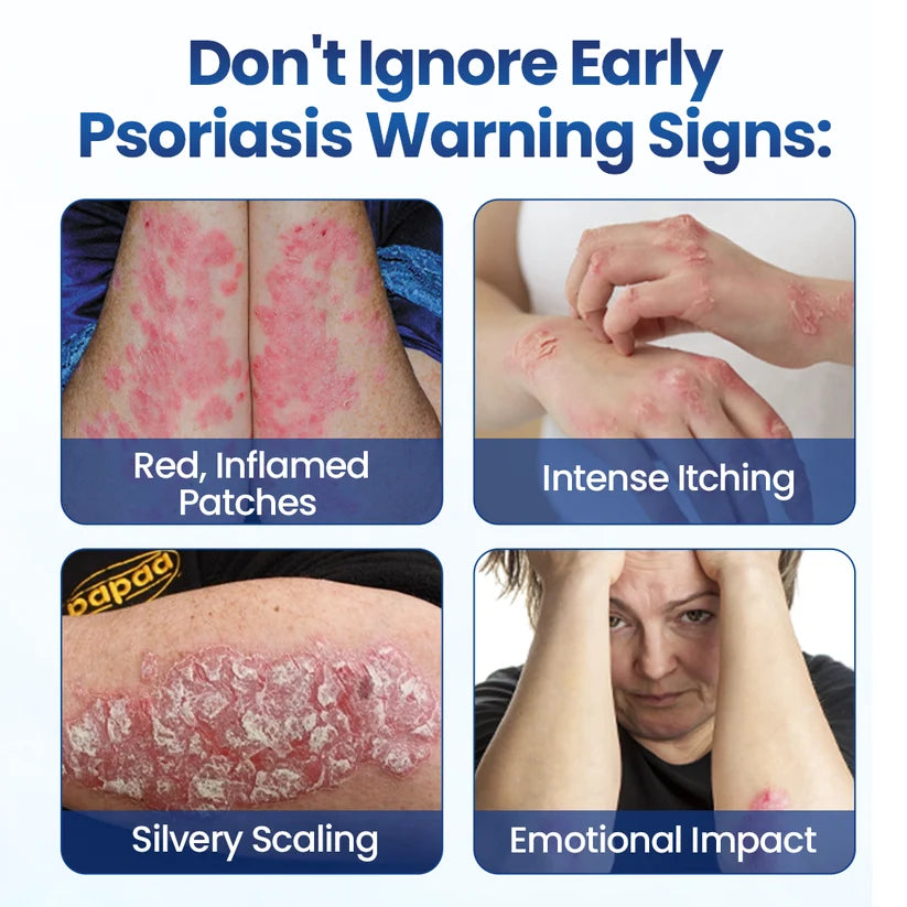 South Moon® PsoriaMucin No-Rub Itch & Flake Relief Mist