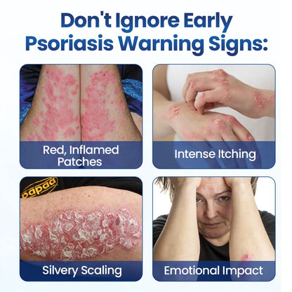 South Moon® PsoriaMucin No-Rub Itch & Flake Relief Mist